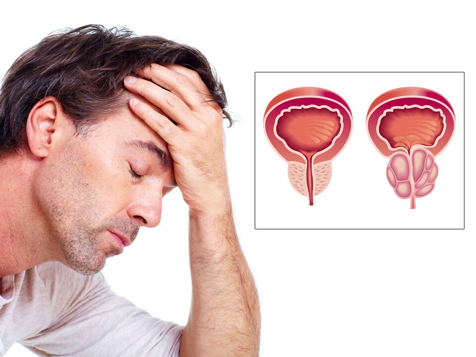 prostatos adenoma su impotencija